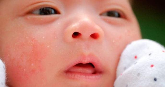 El eritema tóxico, es una afección normal que aparece en los recién nacidos. A pesar de su denominación tóxico, es inofensivo.